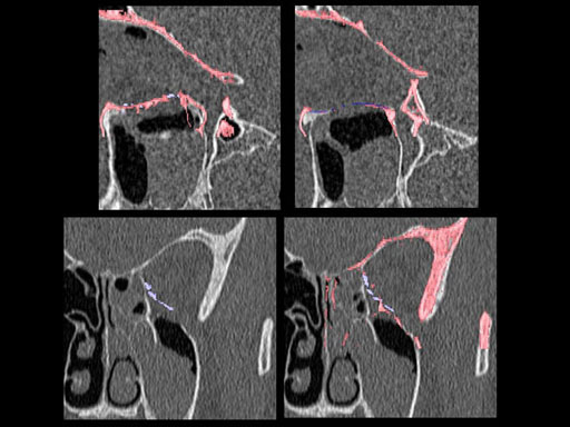 MatrixPreformedOrbitalPlates_16