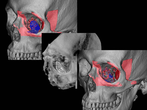 MatrixPreformedOrbitalPlates_17