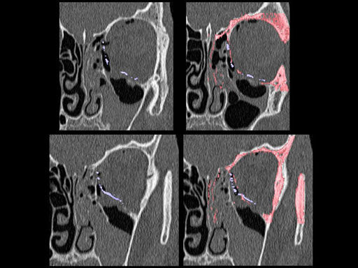 MatrixPreformedOrbitalPlates_18
