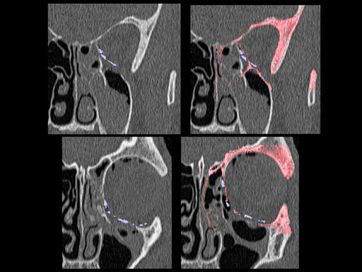 MatrixPreformedOrbitalPlates_19