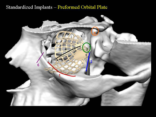 MatrixPreformedOrbitalPlates_20