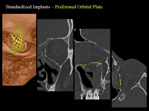 MatrixPreformedOrbitalPlates_21