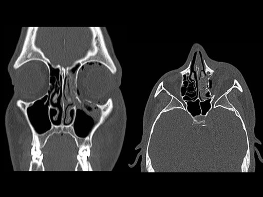 MatrixPreformedOrbitalPlates_4