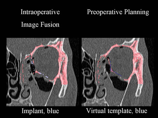MatrixPreformedOrbitalPlates_9