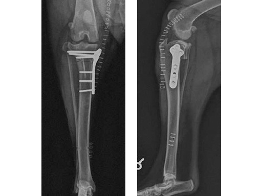 TibiaPlateauLevelingOsteotomySawJig_1