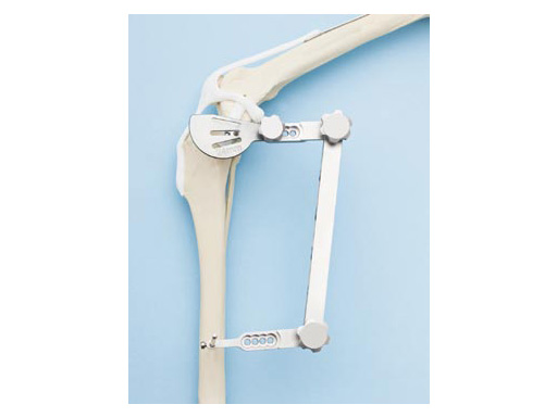 TibiaPlateauLevelingOsteotomySawJig_2