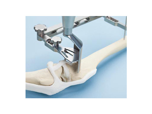 TibiaPlateauLevelingOsteotomySawJig_3