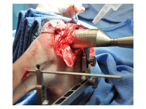 TibiaPlateauLevelingOsteotomySawJig_4