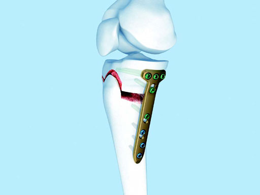 TomoFixHTOSmallStatureAsianVersion_1