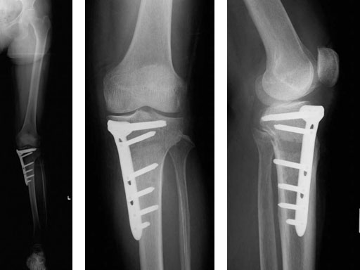 TomoFixHTOSmallStatureAsianVersion_4