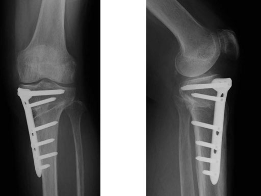 TomoFixHTOSmallStatureAsianVersion_5