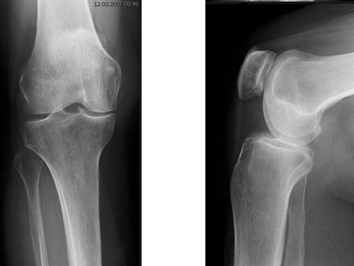 TomoFixMedialHighTibia_3