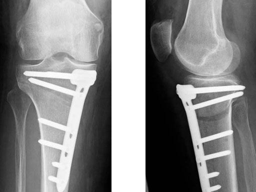 TomoFixMedialHighTibia_5