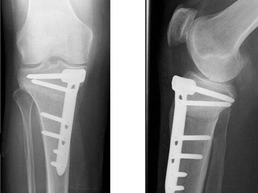 TomoFixMedialHighTibia_6