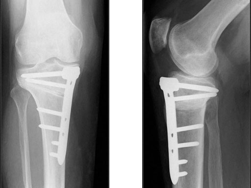 TomoFixMedialHighTibia_7