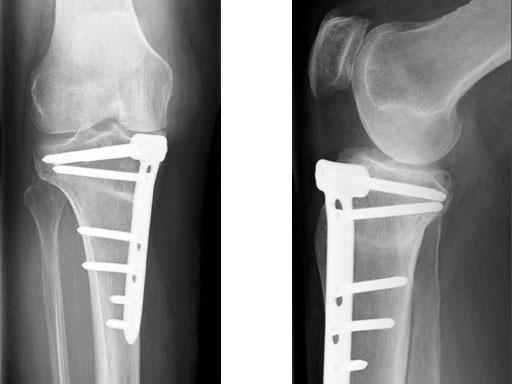 TomoFixMedialHighTibia_8