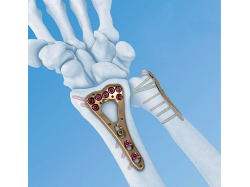 VariableAngleLCPDistalRadiusSystem2-4_1