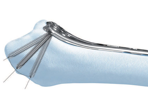 VariableAngleLCPDistalRadiusSystem2-4_2