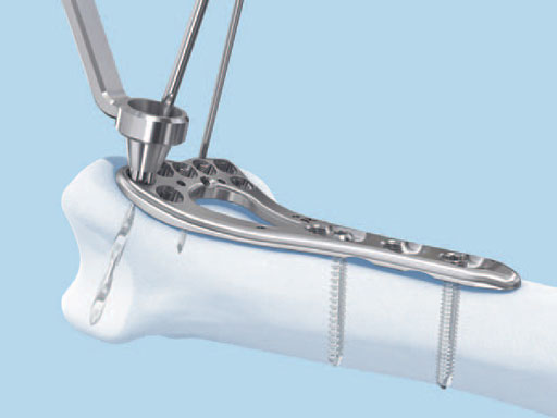 VariableAngleLCPDistalRadiusSystem2-4_4