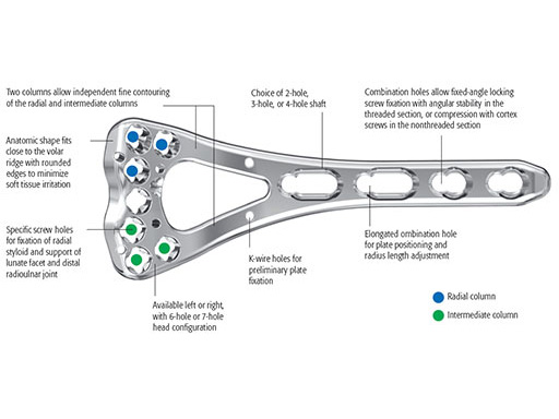 VariableAngleLCPTwoColumnVolarDistalRadius2-4_1