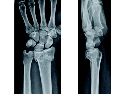 VariableAngleLCPTwoColumnVolarDistalRadius2-4_2