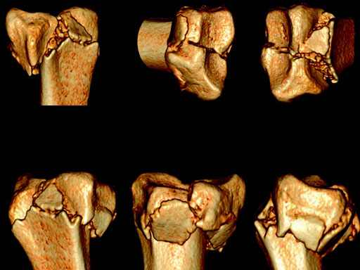VariableAngleLCPTwoColumnVolarDistalRadius2-4_3