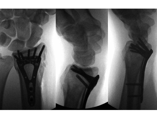 VariableAngleLCPTwoColumnVolarDistalRadius2-4_4
