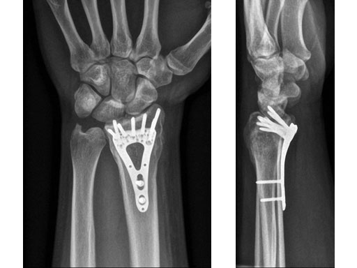 VariableAngleLCPTwoColumnVolarDistalRadius2-4_5