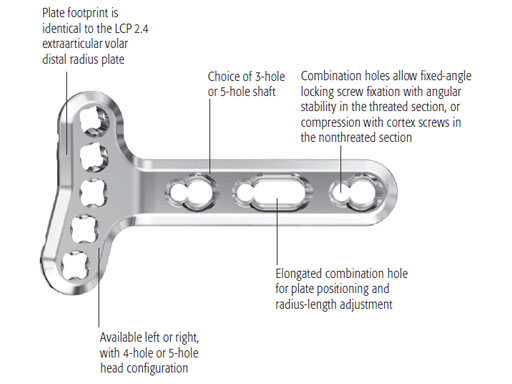 VariableAngleLCPVolarExtraarticularDistalRadius2-4_1