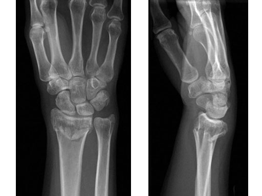 VariableAngleLCPVolarExtraarticularDistalRadius2-4_2