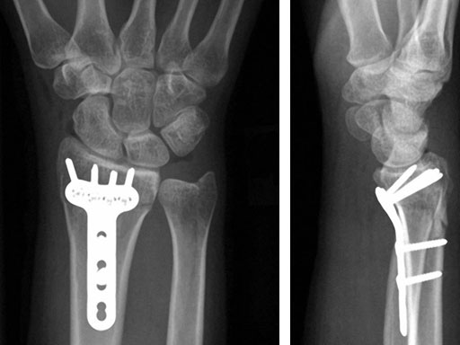 VariableAngleLCPVolarExtraarticularDistalRadius2-4_3