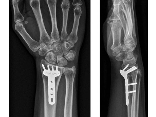 VariableAngleLCPVolarExtraarticularDistalRadius2-4_4