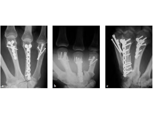 1-5mmLCPModularHandSystem_5