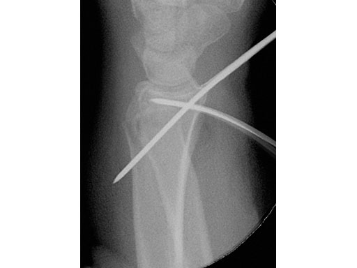 2-4mmVA-LCPTwo-ColumnVolarDistalRadiusNarrowforSmallStature_2