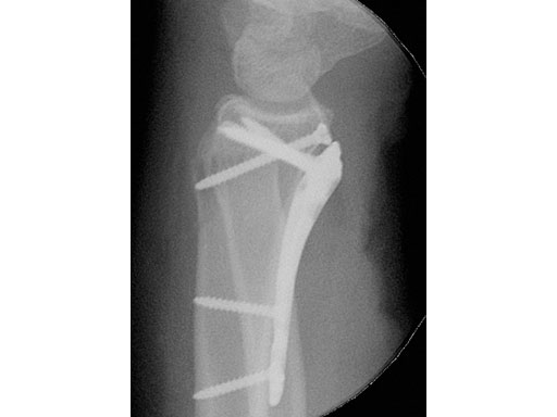 2-4mmVA-LCPTwo-ColumnVolarDistalRadiusNarrowforSmallStature_3