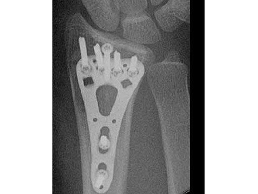 2-4mmVA-LCPTwo-ColumnVolarDistalRadiusNarrowforSmallStature_4