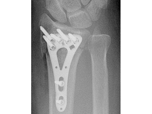 2-4mmVA-LCPTwo-ColumnVolarDistalRadiusNarrowforSmallStature_5