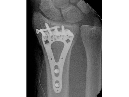 2-4mmVA-LCPTwo-ColumnVolarDistalRadiusNarrowforSmallStature_6