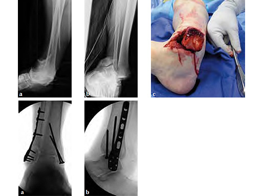 2-7_3-5mmLCPLateralDistalFibula_4