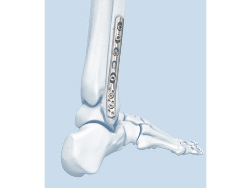 2-7_3-5mmLCPPosterolateralDistalFibula_2