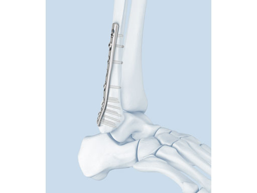 2-7_3-5mmLCPPosterolateralDistalFibula_3