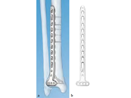 3-5LCPDistalTibiaT-Plate_1