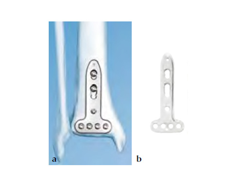3-5LCPDistalTibiaT-Plate_2