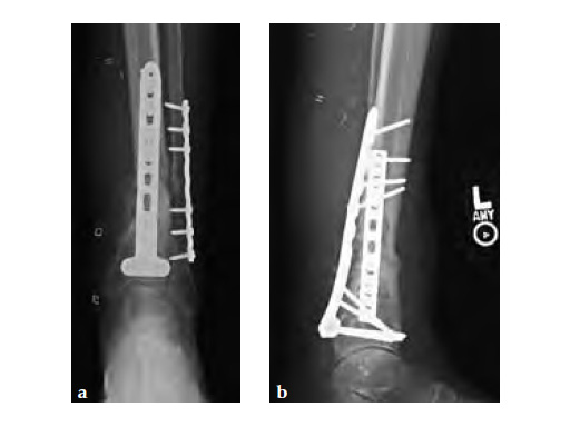 3-5LCPDistalTibiaT-Plate_4