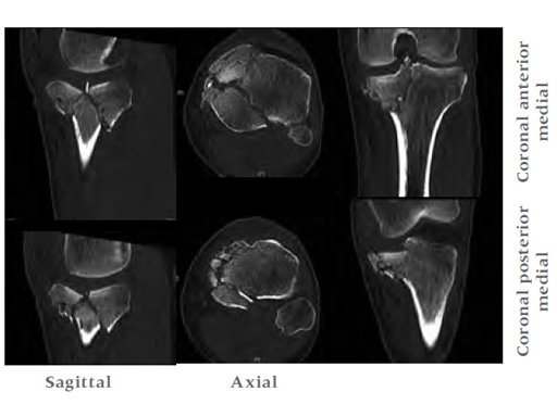 3-5LCPPosteromedialProximalTibiaPlate_4