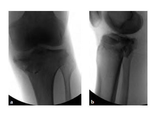 3-5LCPPosteromedialProximalTibiaPlate_5