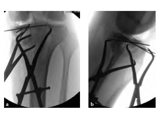 3-5LCPPosteromedialProximalTibiaPlate_6