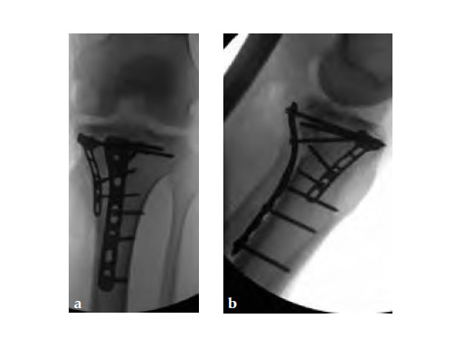 3-5LCPPosteromedialProximalTibiaPlate_7