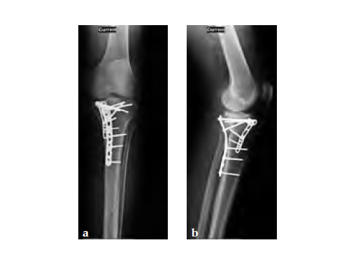 3-5LCPPosteromedialProximalTibiaPlate_8