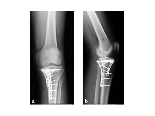 3-5LCPPosteromedialProximalTibiaPlate_9